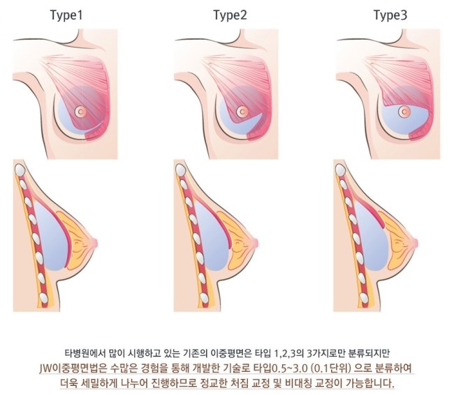 [JW정원성형외과] 처진가슴! 거상없이 확대수술만으로 해결! JW정원 처짐교정확대술 관련 이미지 5