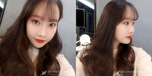 JW정원성형외과 자가지방이식으로 아름다움 완성♥ 관련 이미지 3