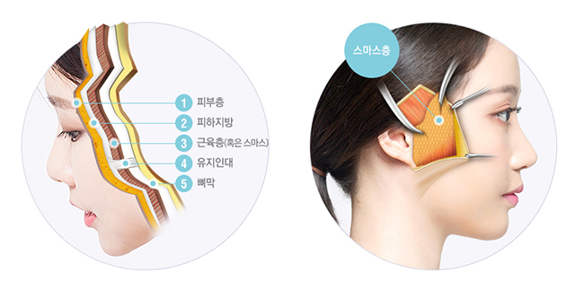 강력한 리프팅 효과로 동안 유지▷▶JW정원성형외과 스마스 조각 리프팅 관련 이미지 2