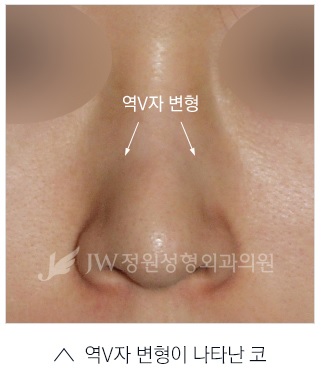 매부리코 교정? JW정원성형외과만의 핵심 노하우 공개! 관련 이미지 1