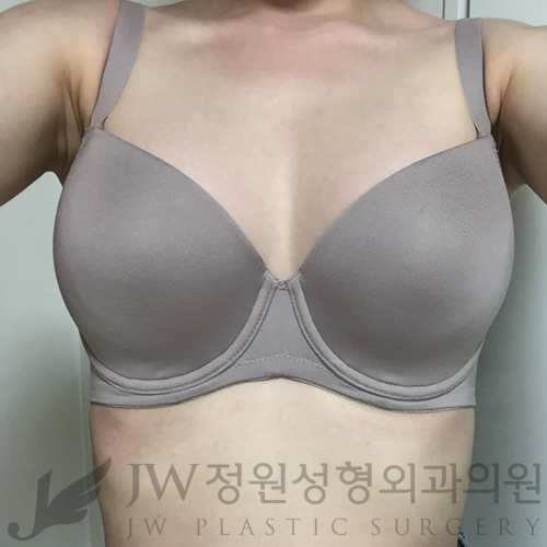 [JW정원성형외과]더 자연스러운 가슴성형, 콤비네이션가슴확대♡ 관련 이미지 7