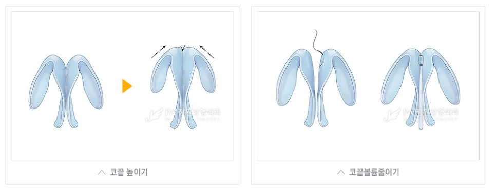 빙글빙글 돌아가는 무보형물 코수술 [코끝성형] 관련 이미지 4