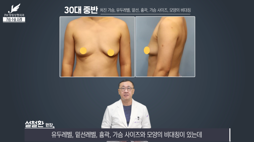 처진가슴교정 치밀한 계획으로 완성도는 UP! 【강남 JW정원성형외과】 관련 이미지 4