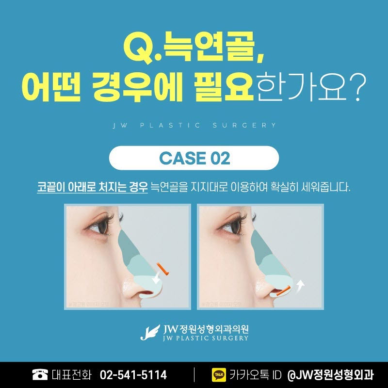 Where to Get Good Nose Surgery: A Sleeker Shape Using Rib Cartilage image 5