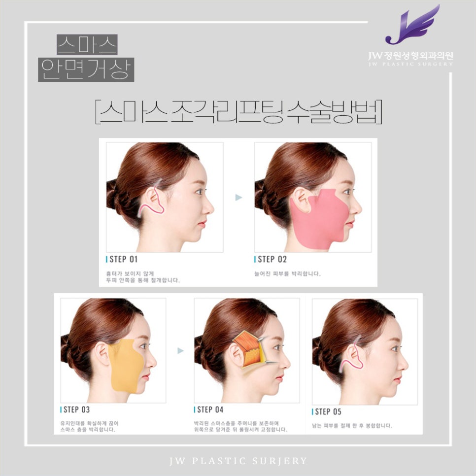SMAS Facelift!? Just Right for Facial Wrinkle Lifting! image 6