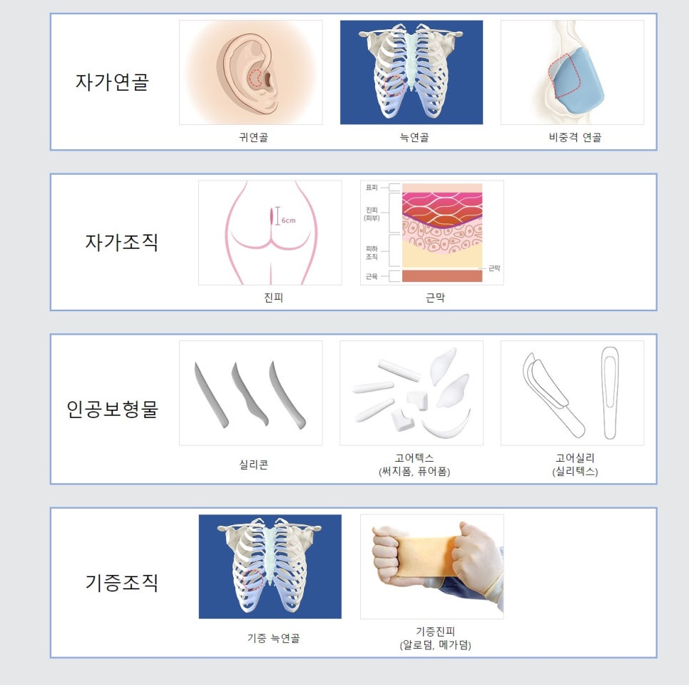 밋밋한 얼굴을 입체감 있는 얼굴로, 낮은코성형후기로 알아봐요 관련 이미지 3