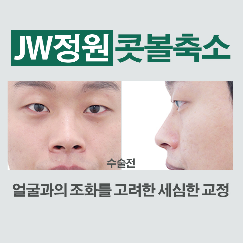 촌스러움 노노! 세련된 라인, JW정원성형외과 콧볼축소 관련 이미지 3
