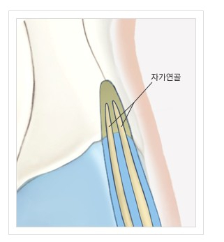 Hump Nose Correction for a Smooth Line Without Recurrence image 7