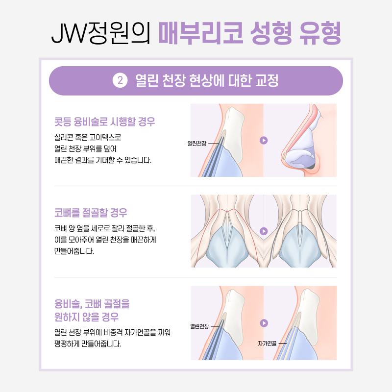 Hump Nose Surgery Cost: If You Want a Softer Line image 6
