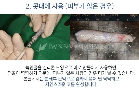 [JW정원성형외과] 코성형, 어려울수록 자신 있습니다! 관련 이미지 5