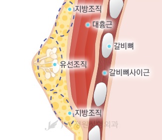[JW정원성형외과]여유증, 여성형유방 수술로 해결하세요! 관련 이미지 6