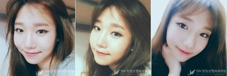 밋밋한 얼굴에서 상큼하고 매력적인 얼굴로♡JW정원 코+윤곽성형 관련 이미지 5