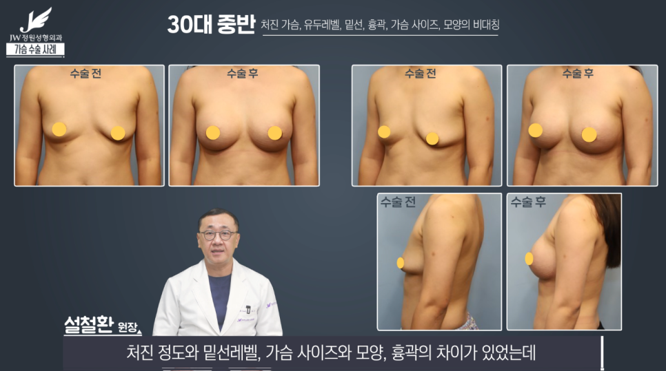 처진가슴교정 치밀한 계획으로 완성도는 UP! 【강남 JW정원성형외과】 관련 이미지 13