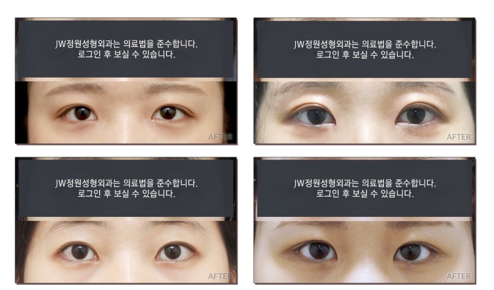 절개/비절개눈매교정, 나에게 맞는 눈매교정술은? 관련 이미지 6