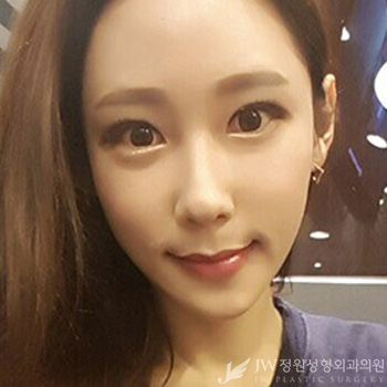 [JW정원성형외과] 턱끝재수술, 비절개눈매교정으로 동안 완성♡ 리얼셀카 관련 이미지 7