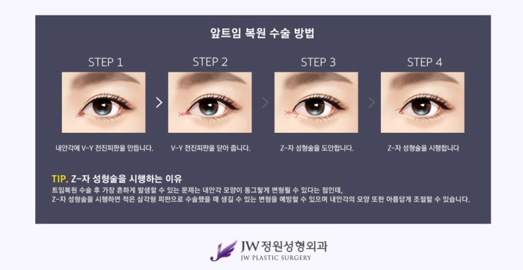 [JW정원성형외과] 앞뒷트임 재수술.복원 알아본다면? 트임복원 잘하는 곳에서! 관련 이미지 4