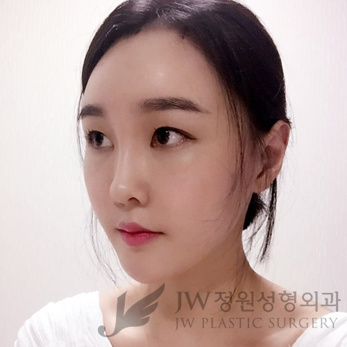 이마눈썹리프팅,눈매교정술,앞트임복원,코성형,지방이식 &rArr; JW정원성형외과에서! 관련 이미지 3