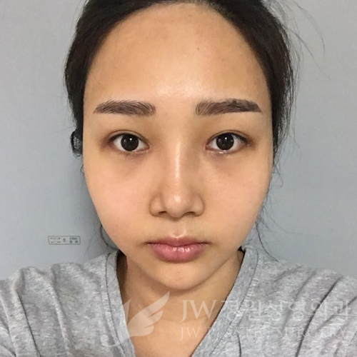 JW정원성형외과에서 매몰쌍꺼풀,앞트임,듀얼트임,코성형,넥리프팅으로 여신효과♡ 관련 이미지 8