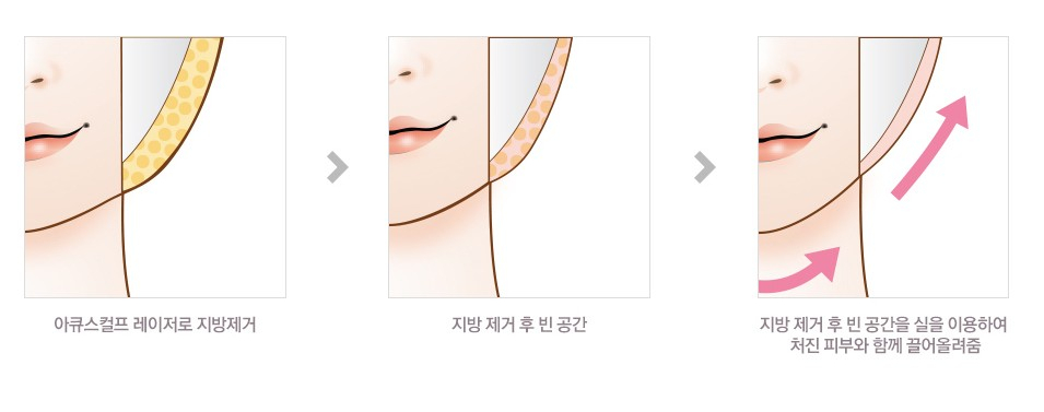 [JW Jeongwon Plastic Surgery] Sagging cheeks and a collapsed facial line! Compress and lift with a double lifting procedure image 3