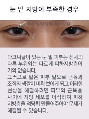 울퉁불퉁한 눈 밑, 피곤해 보이는 눈 밑 JW정원 눈밑지방재배치로 고민 해결! 관련 이미지 2