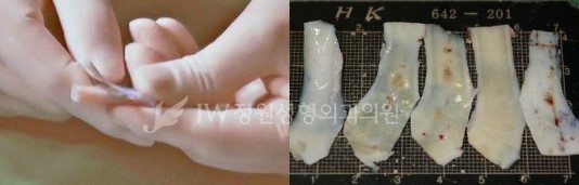 재수술이 아닌 마지막 수술! JW정원성형외과 늑연골코성형 관련 이미지 6