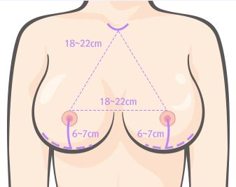 내트렐 510, JW정원성형외과에서 만나보세요! (앨러간) 관련 이미지 6