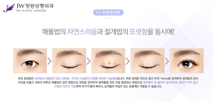 [JW정원성형외과] 나에게 맞는 눈성형 찾기! 관련 이미지 7