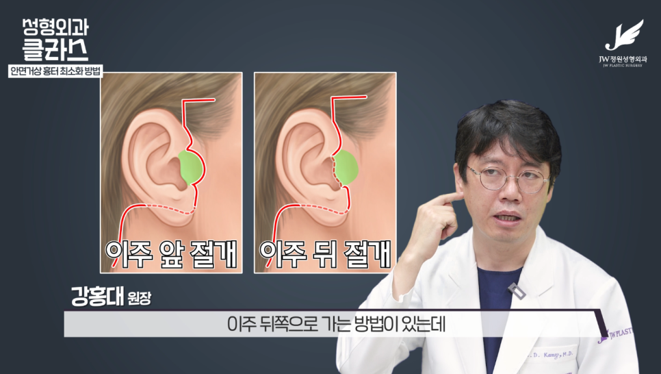 안면거상술후기 흉터 걱정 없이 깔끔하게!  【강남 JW정원성형외과】 관련 이미지 5
