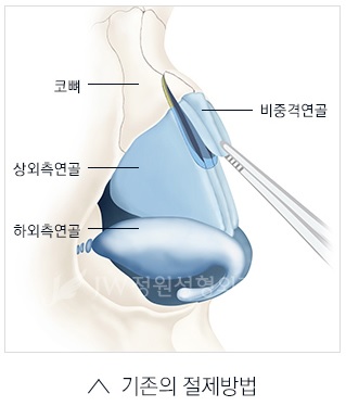 매부리코 교정? JW정원성형외과만의 핵심 노하우 공개! 관련 이미지 2