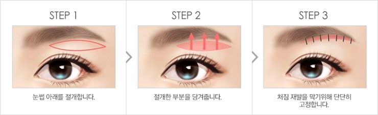 탄력있는 눈매로 확실하게 젊어지는 JW정원성형외과 상안검성형 관련 이미지 7