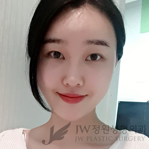 이마눈썹리프팅,눈매교정술,앞트임복원,코성형,지방이식 &rArr; JW정원성형외과에서! 관련 이미지 5