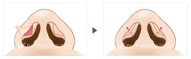 촌스러운 이미지에서 세련된 인상으로! JW정원성형외과 콧날개교정술 관련 이미지 4