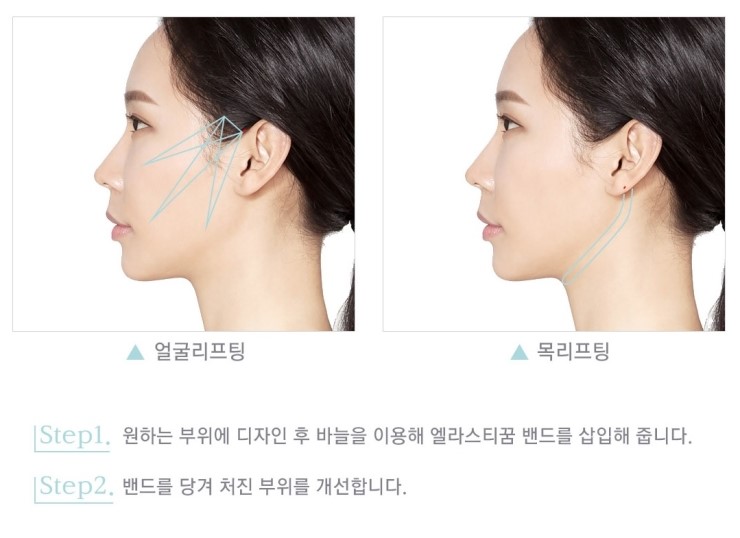 보다 탄력있게 오랜 지속효과까지! JW정원성형외과 엘라스티꿈 리프팅 관련 이미지 5