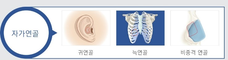 [JW정원성형외과] 코성형, 나에게 적합한 보형물은? 관련 이미지 2