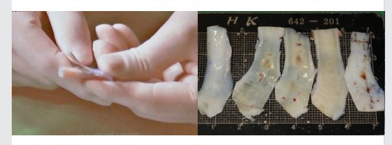 Silicone Side Effects: Safe and Beautiful Revision Rhinoplasty with Autologous Rib Cartilage! image 4
