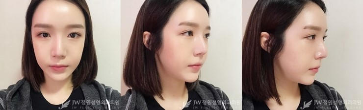 [JW정원성형외과] 지방이식+코재수술로 입체감 있는 얼굴완성♡ 관련 이미지 5