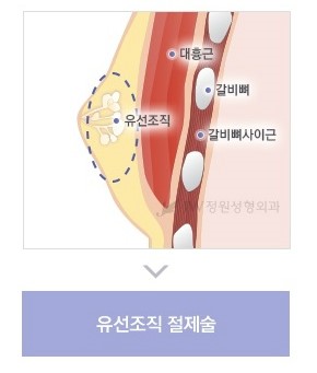 불룩한 가슴으로 고민이라면? 여성형유방(여유증) 성형도 역시 JW정원성형외과! 관련 이미지 5