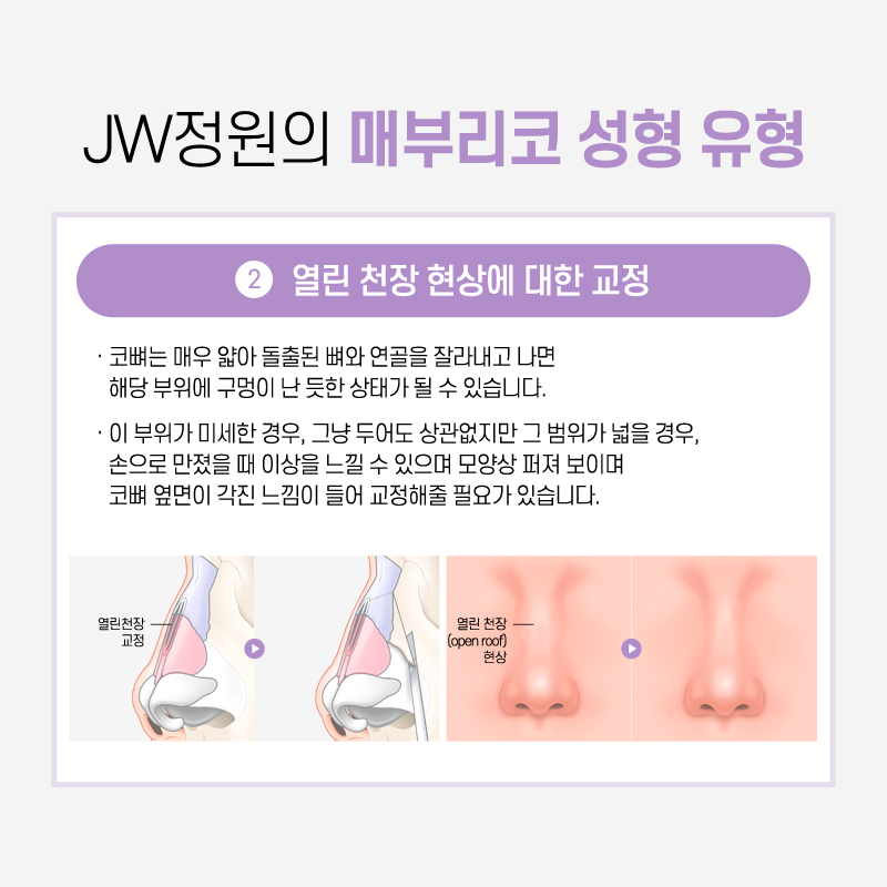 Hump Nose Surgery Cost: If You Want a Softer Line image 5