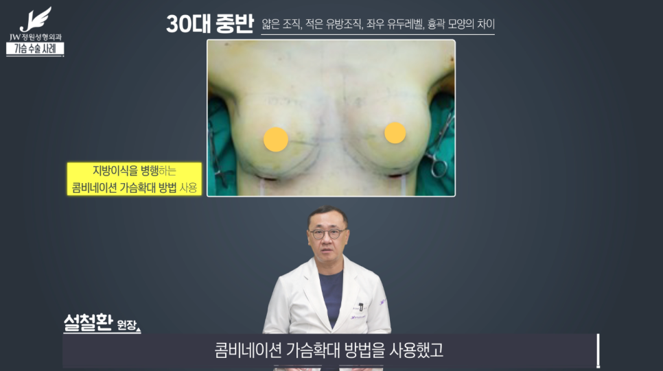 가슴성형수술전후 개인별 맞춤으로 꼼꼼하게! 【강남 JW정원성형외과】 관련 이미지 5