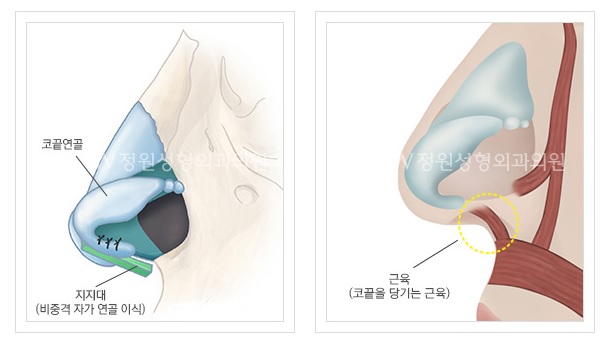 매부리코 교정 A to Z, JW정원성형외과 매부리코 교정 관련 이미지 3