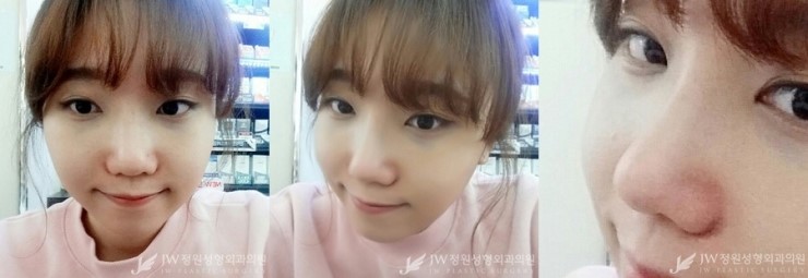 밋밋한 얼굴에서 상큼하고 매력적인 얼굴로♡JW정원 코+윤곽성형 관련 이미지 2