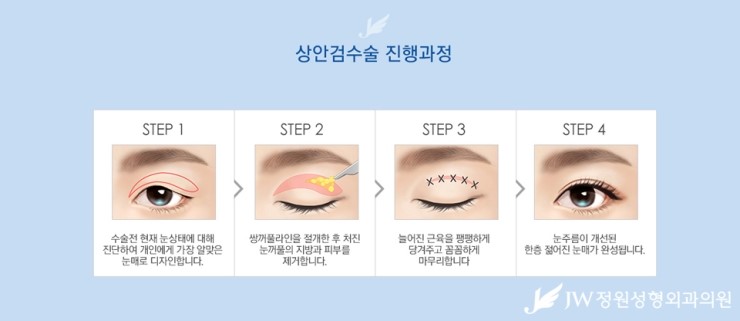 [JW정원성형외과] 처진 눈꺼풀을 탄력 있는 눈매로! 상안검성형 관련 이미지 5