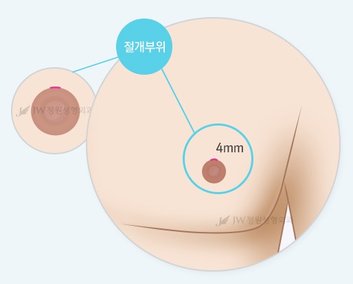 [JW정원성형외과]여유증, 여성형유방 수술로 해결하세요! 관련 이미지 3