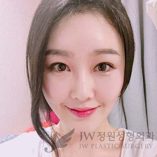 이마눈썹리프팅,눈매교정술,앞트임복원,코성형,지방이식 &rArr; JW정원성형외과에서! 관련 이미지 19