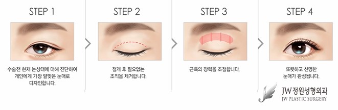 피곤해보이는 졸린 눈을 생기 있게 바꾸는 눈매교정술 관련 이미지 2