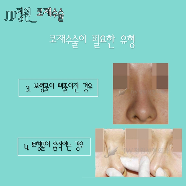 Nose revision surgery is definitely at JW Jeongwon Plastic Surgery! image 6