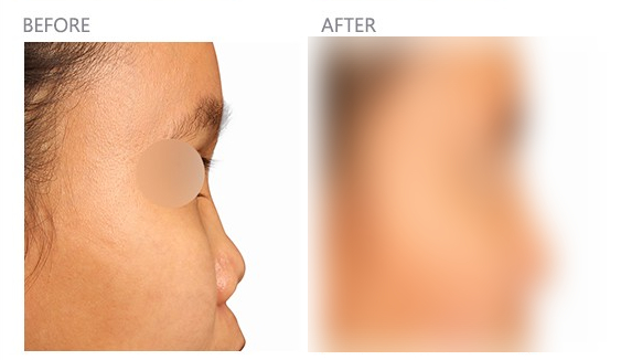 Collapsed Nose Revision Surgery, Safe Without Rejection Using Autologous Rib Cartilage! image 3