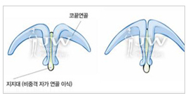 사나운 매부리코 고민을 해결해주는 매부리코성형​ 관련 이미지 3
