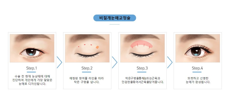 절개/비절개눈매교정, 나에게 맞는 눈매교정술은? 관련 이미지 5