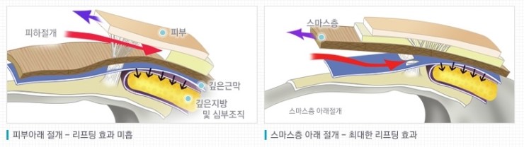 강력한 리프팅 효과로 동안 유지▷▶JW정원성형외과 스마스 조각 리프팅 관련 이미지 3